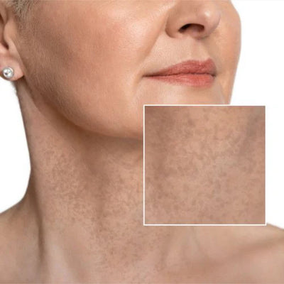 Uneven Skin Tone