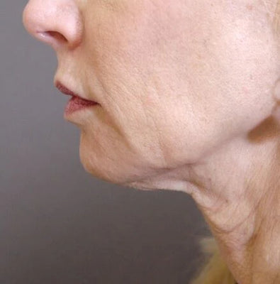 Turkey Neck